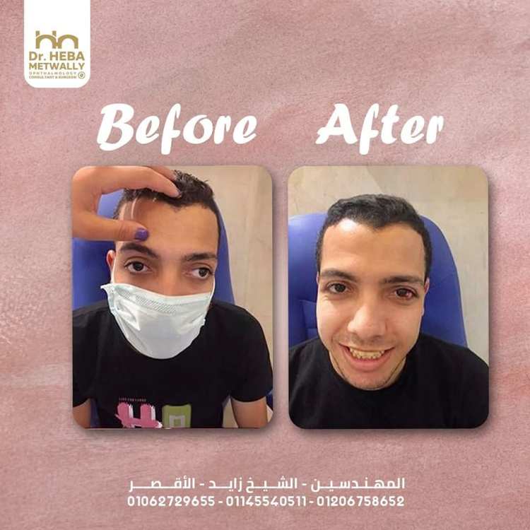أنواع حول العيون